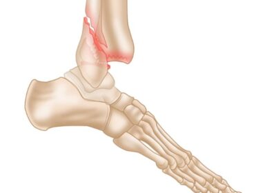 Ankle-Fracture-Small