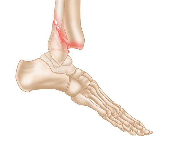 Ankle Fracture