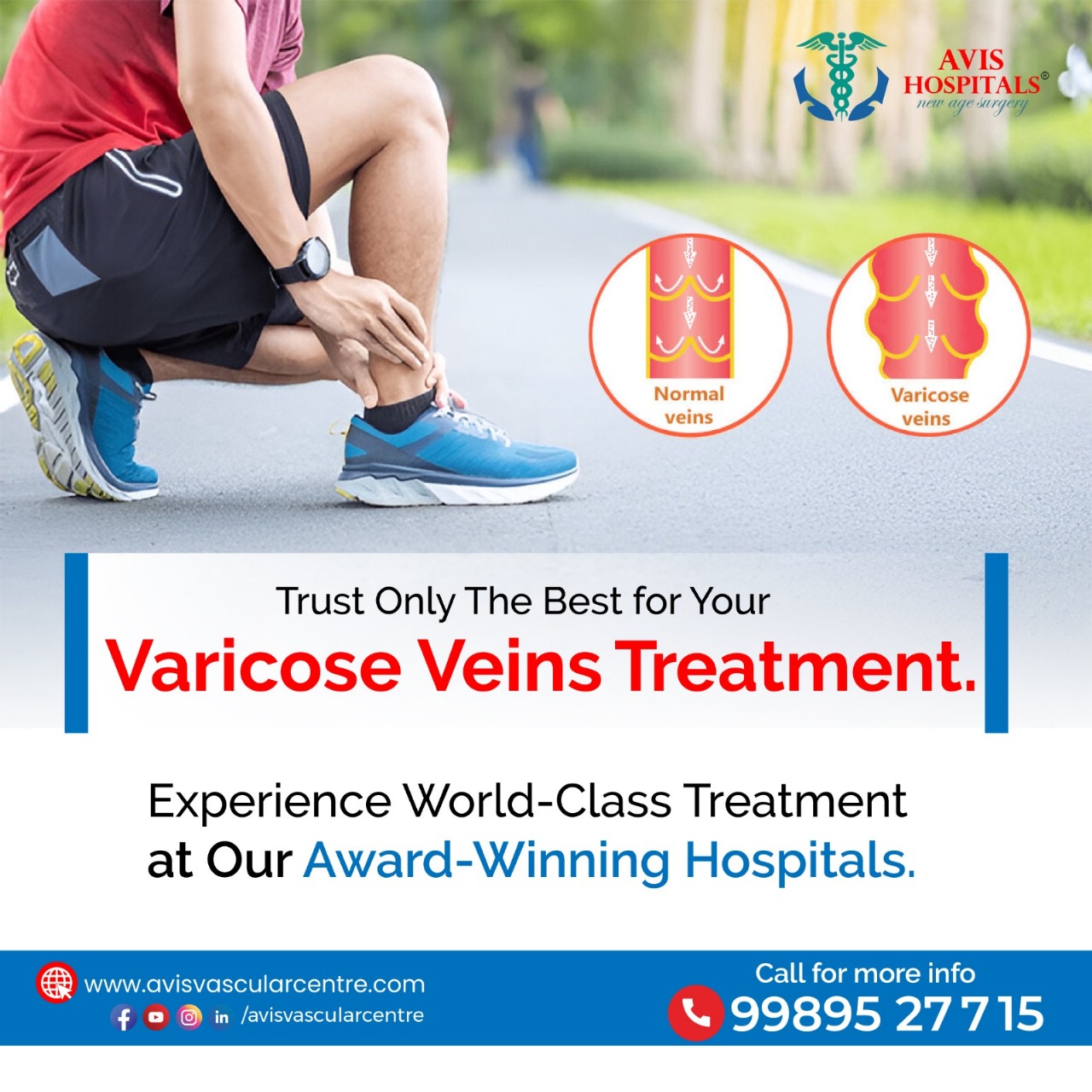 Best and advanced Laser Varicose Veins Treatment in Hyderabad – Avis Vascular Centre