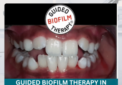 Guided-Biofilm-Therapy-in-Hyderabad
