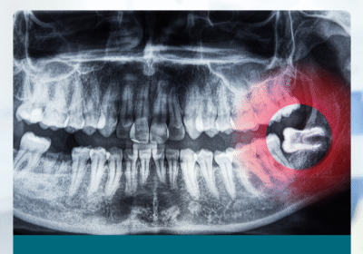 Wisdom-Tooth-Extraction