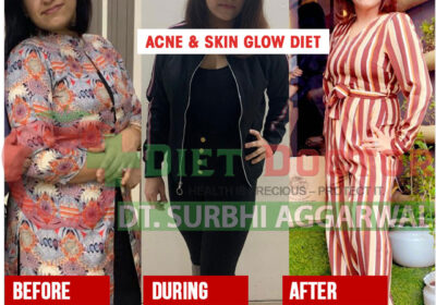 dietitian-surbhi-transformation-Acne-skin-glow-Diet