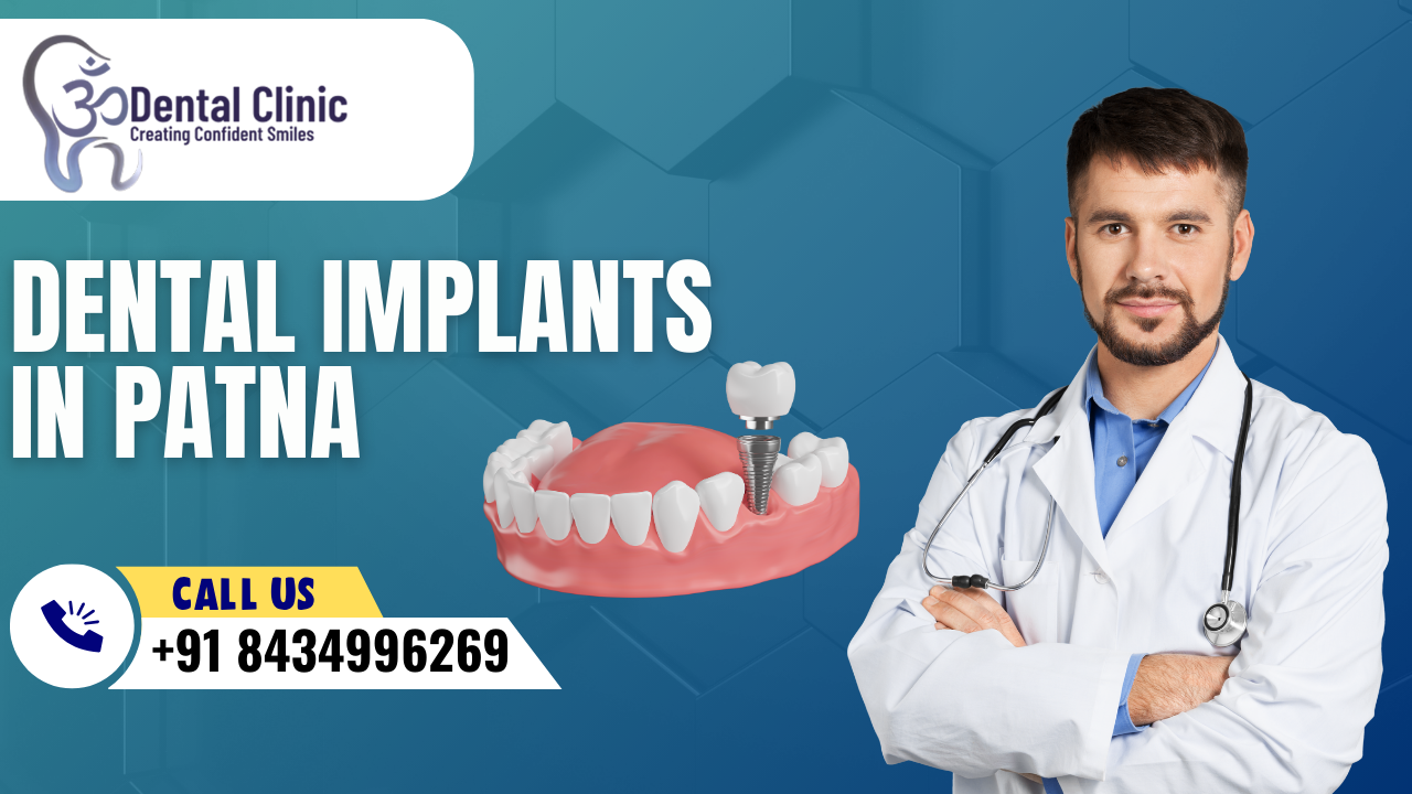 Dental Implants In Patna | Dental Implants Treatment In Patna