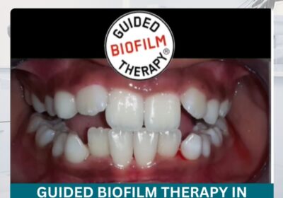 Guided-Biofilm-Therapy-in-Hyderabad-1