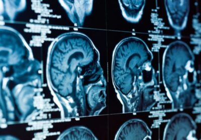service-neuro-oncology