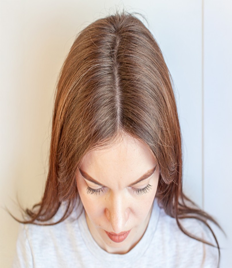 Female Hair Transplant In Mumbai – Cara Clinic